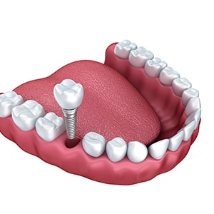 Dental Implants Sunset Utah