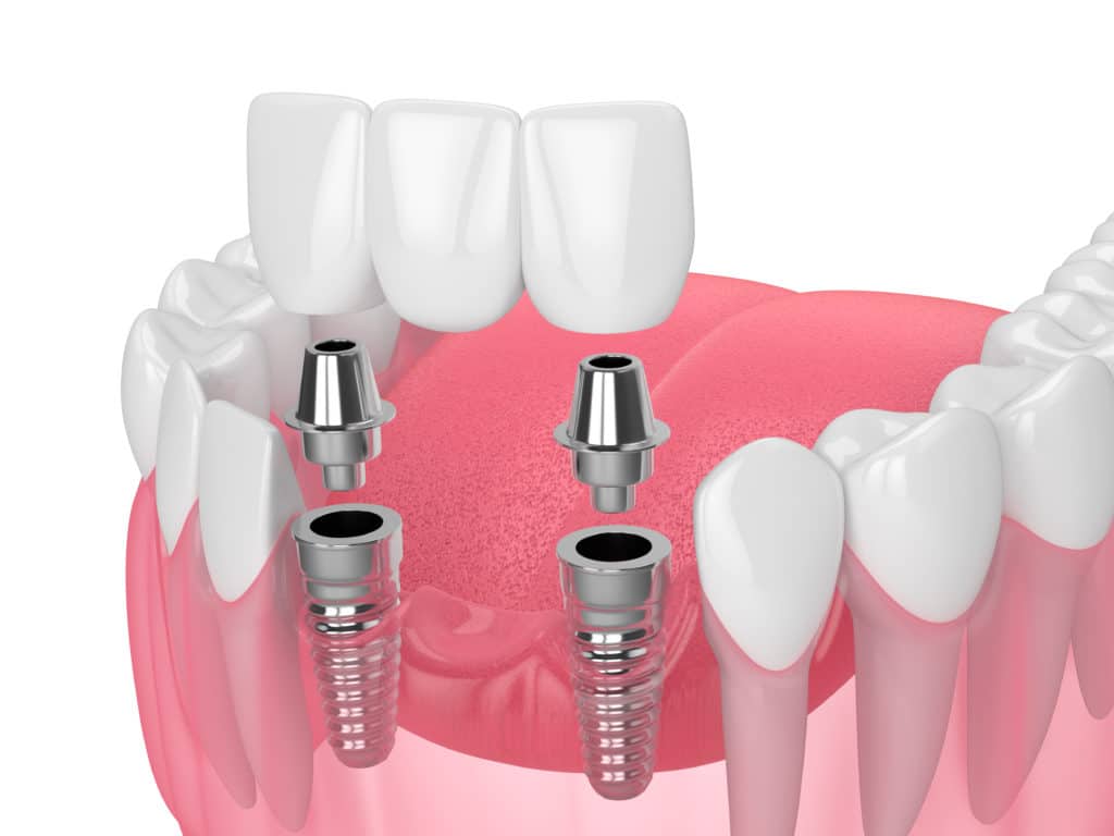 Sunset Utah dental implants
Restorative Dentistry