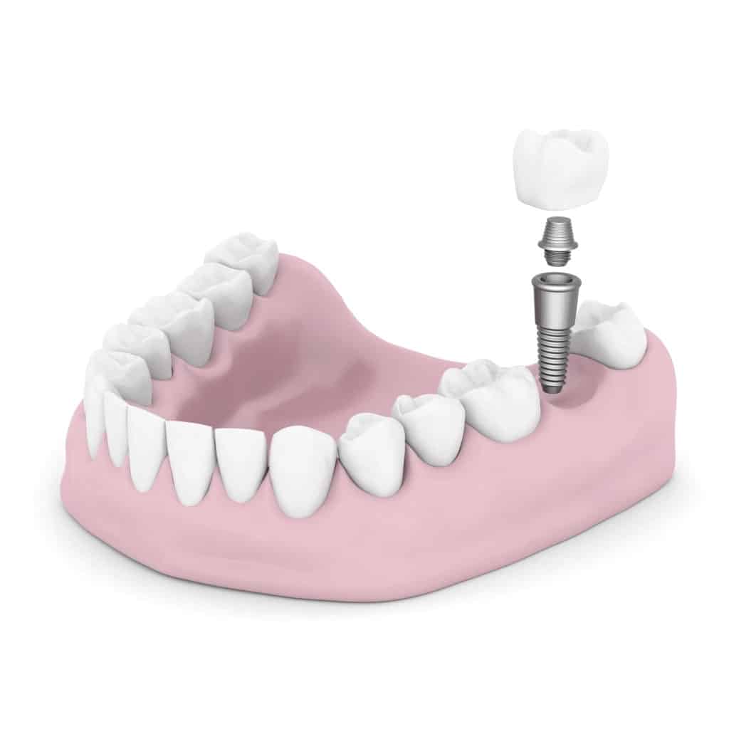 Dental Implants vs. Dental bridges