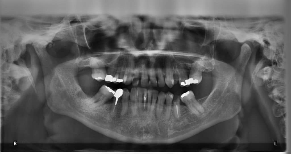 Sunset Dental xrays