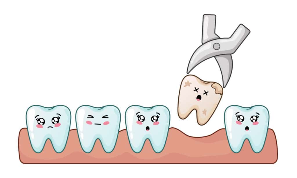 More About Tooth Extraction