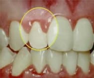 What to do when you have inflamed gums?