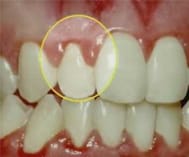 What To Do When You Have Inflamed Gums What to do when you have inflamed gums?