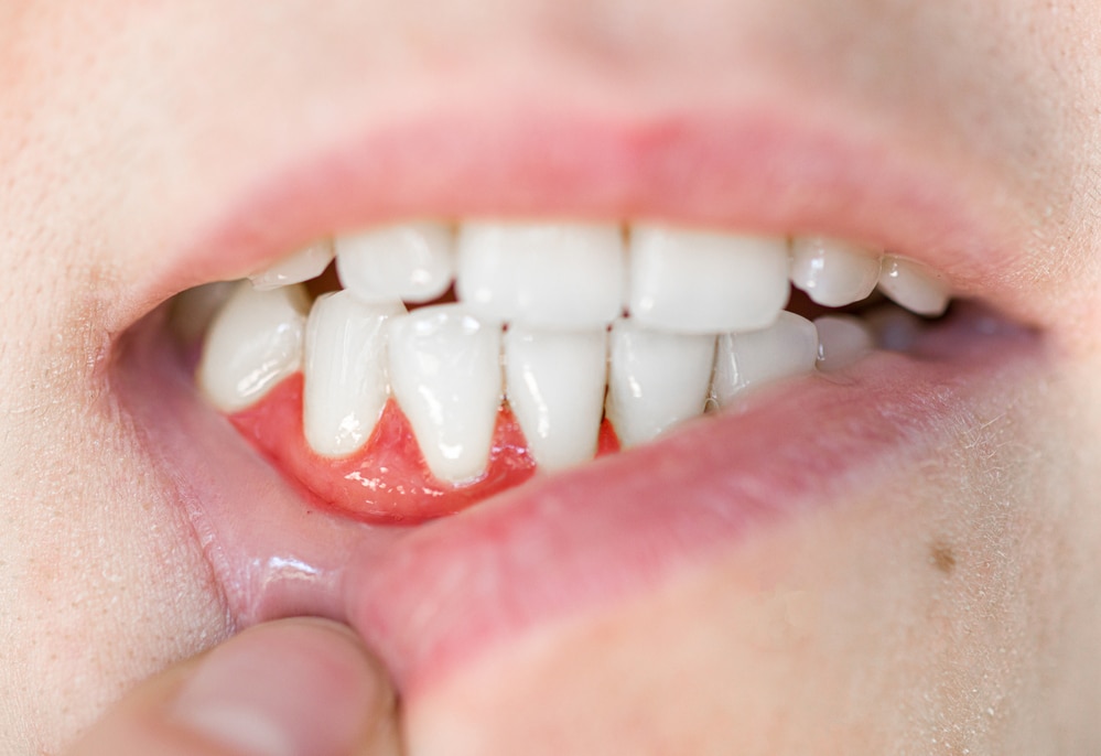 Inflamed gums or gum disease