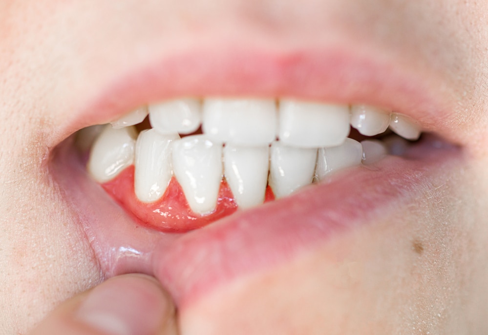 Inflamed gums or gum disease