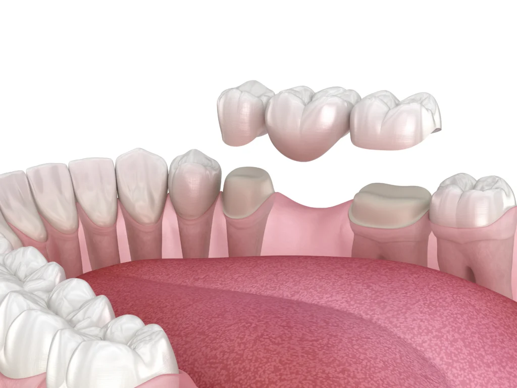 How porcelain crowns strengthen teeth