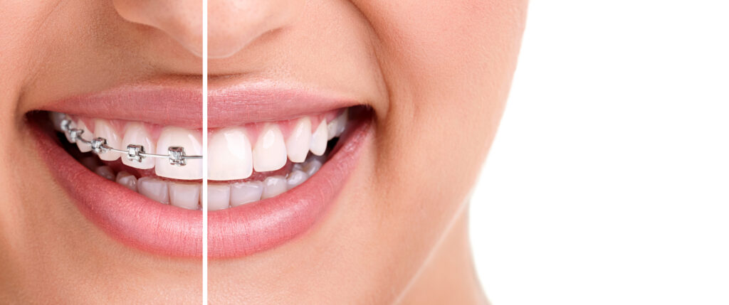 fix gaps and misaligned teeth without braces